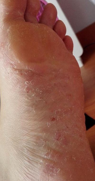 脚上起小水泡很痒是怎么回事述脱皮（脚上起小水泡很痒是怎么回事述脱皮用药）