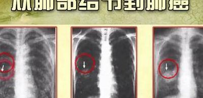 肺上有结节是怎么治疗（肺上出现结节怎么办）